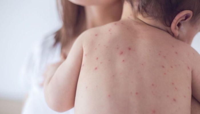 ​7 more children die with measles-like symptoms in 24 hours